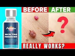 Paradise Skin Tag Remover
